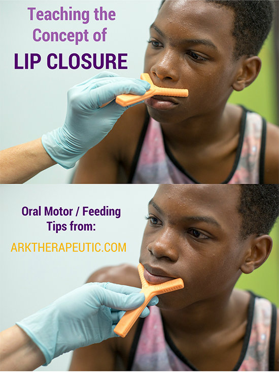 Assisting Lip Closure