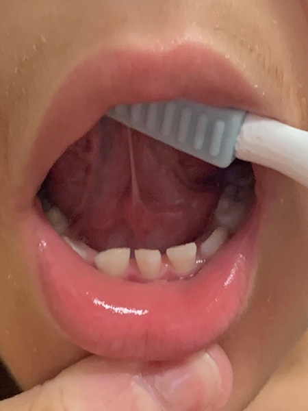 5 Ways to Easily Assess Tongue-Ties Using ONE Simple Tool Closeup of the mouth: a therapist uses the Probe to lift the tongue to look for a tongue tie